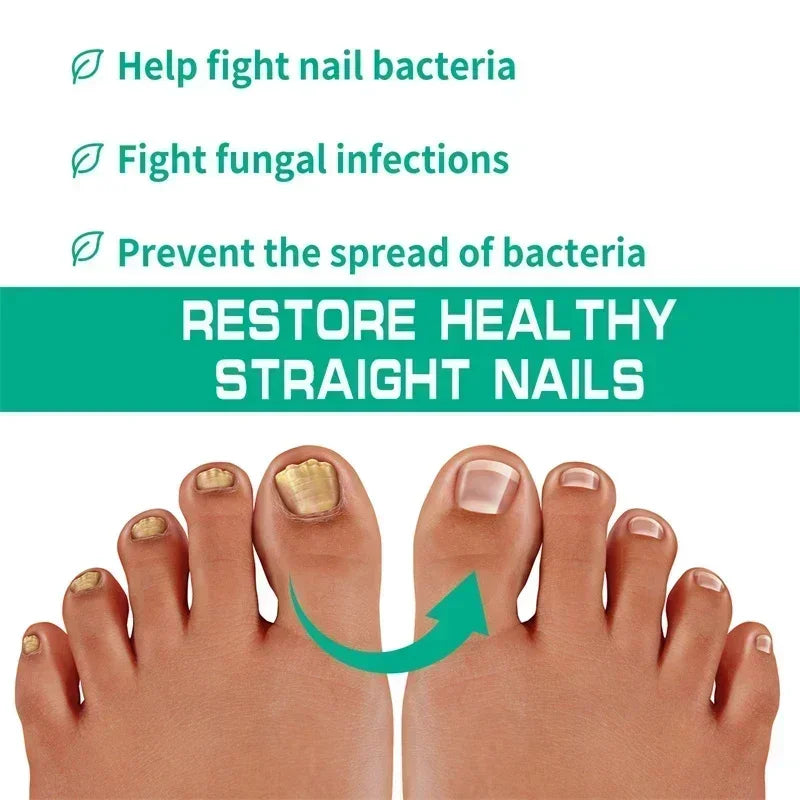 Nail Fungus Treatment Serum Toe Fungal Repair Products Hand Foot Care Removal Gel Anti Infection Paronychia Onychomycosis