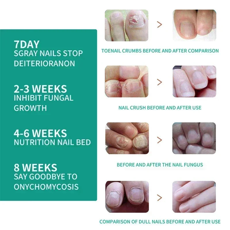 Nail Fungus Treatment Serum Toe Fungal Repair Products Hand Foot Care Removal Gel Anti Infection Paronychia Onychomycosis
